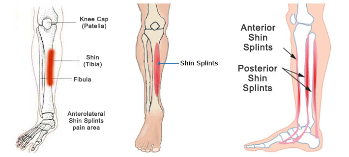 Shin splints physiology